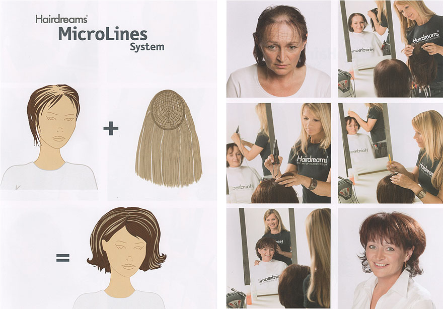 Veranschaulichung der Methode zur Haarverdichtung (Hairdreams MicroLines System) inklusive Vorher Nachher Vergleich